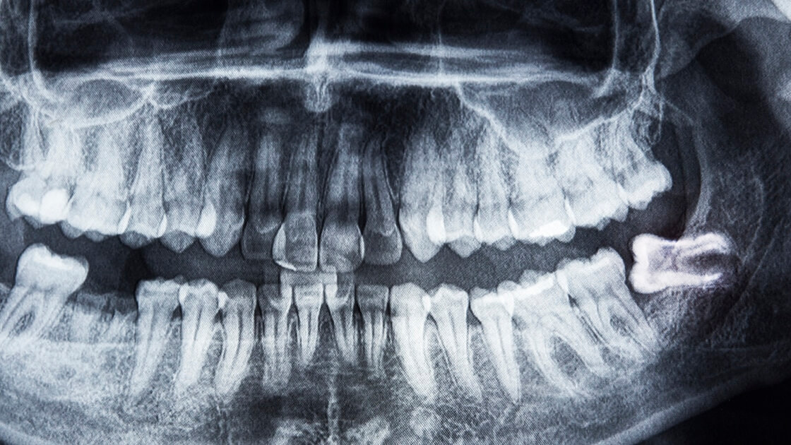 Xray with Impacted 3rd Molar